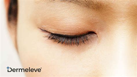 No More Itchy Eyelids Treat Eyelid Dermatitis And Ocular Pruritus Dermeleve®