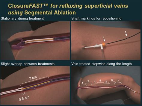 Lower Limb Venous Ablation