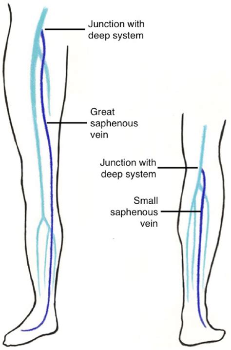 Superficial Venous Thrombosis