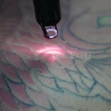 Tattoo Removal Youtube