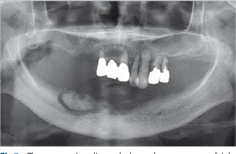 Osteonecrosis Of The Jaw Radiograph