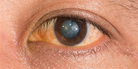 Nuclear Cataract Signs Causes And Treatment