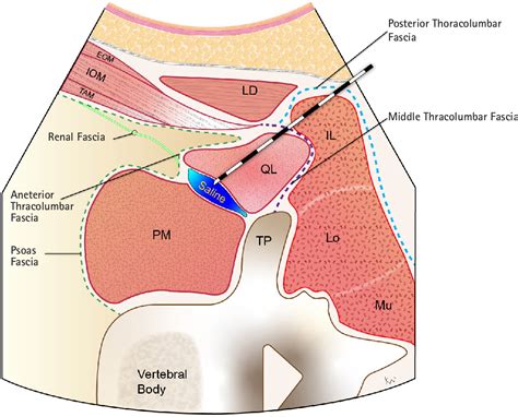 Figure 2 From Continuous Quadratus Lumborum Block As Part Of Multimodal