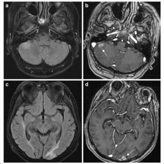 Follow-up brain MRI of the patient. FLAIR images (a and c) and ...