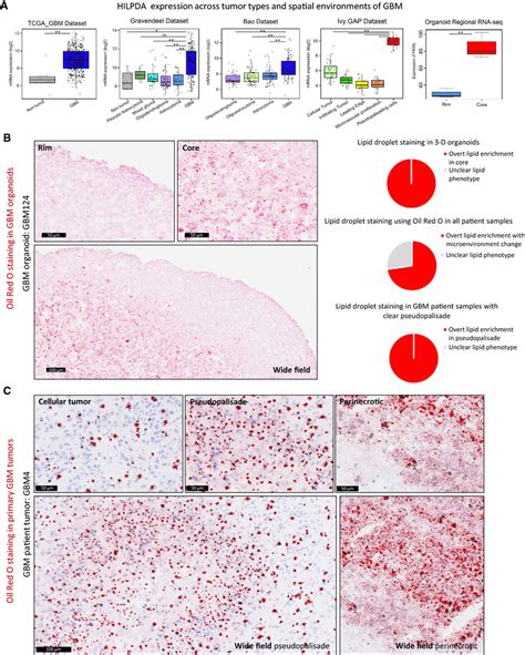 Lipid Droplet Accumulation In Perinecrotic And Pseudopalisading Tumor