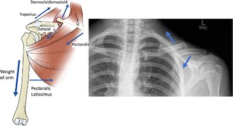 Figure 1 From Management Of Displaced Midshaft Clavicle Fractures In Pediatrics And Adolescents