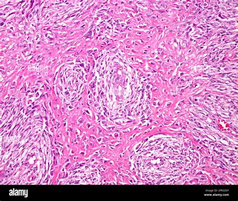 Fibroblastic osteosarcoma, light micrograph Stock Photo - Alamy