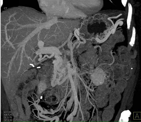 Pancreatic Cancer Encases And Occludes The Portal Vein Smv Confluence