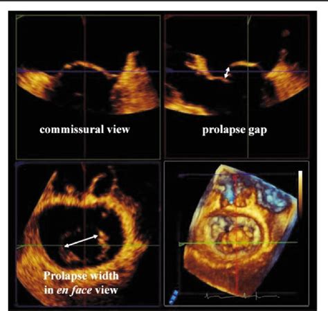 Figure From Quantification Of Mitral Valve Morphology With Three