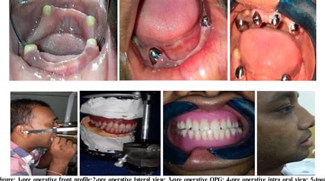 PDF Case Reports On Tooth Supported Overdenture Dr Semantic Scholar