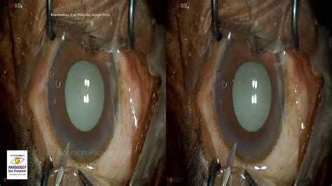 Dr Sourabh Patwardhan Live Cataract Surgery For Training And Consultation Call 7028402375 Youtube