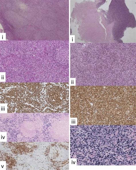 Figure The Histological Findings Of The Biopsy Specimens From