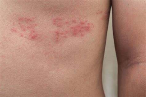 Shingles Clear Choice Dermatology