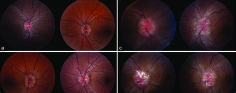 Fundus photographs demonstrating mild and severe papilledema. Mild ...