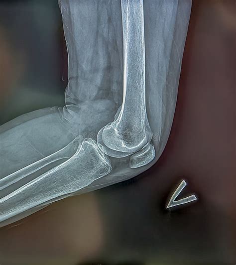 X-ray Shows the Skeleton of the Knee on Film. Surgical Medical ...