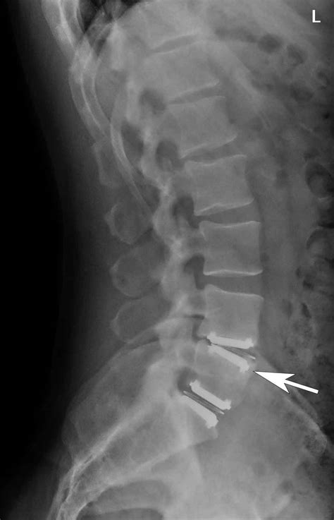 (Click to Enlarge Image) Side view X-ray of the artificial discs. The ...