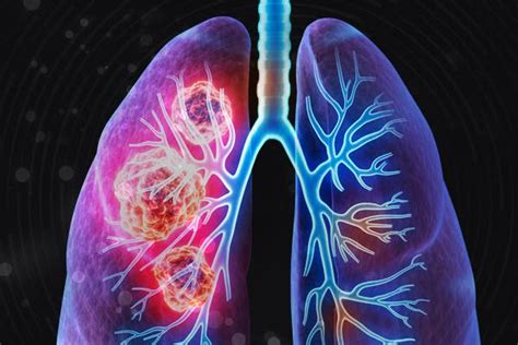 PRIME Online Activity IO Therapy For Metastatic Non Small Cell Lung