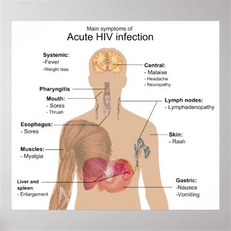 Main Symptoms of Acute HIV Infection Poster | Zazzle