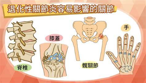 外科专科医生白映俞／僵硬、疼痛，退化性关节炎怎么办？ 副刊 养生 照护线上