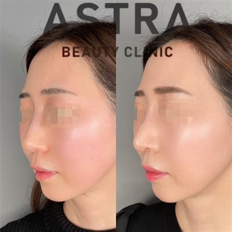 隆鼻術鼻尖形成軟骨移植 【公式】astra Beauty Clinic（アストラビューティクリニック）｜美容外科・美容皮膚科・形成外科