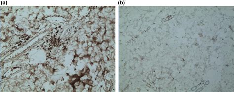 Primary Localized Cutaneous Nodular Amyloidosis Presenting As Lymphatic Malformation A Case