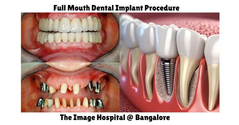 Full Mouth Dental Implants Full Mouth Dental Implant Procedure The Image Hospital