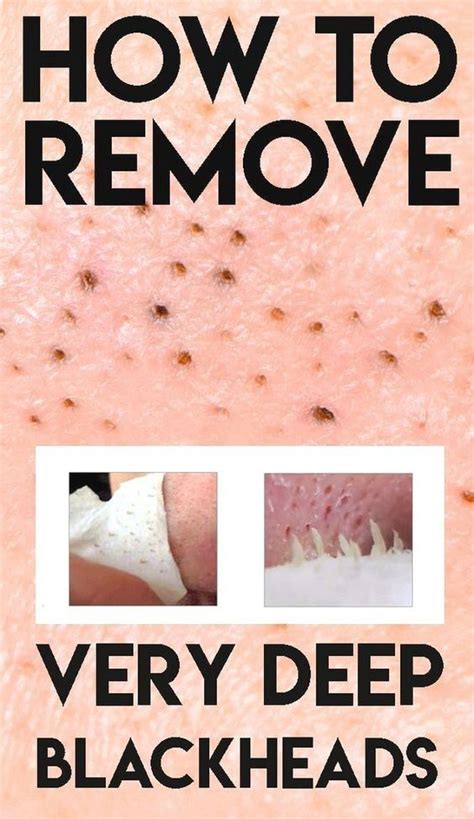 8 Diy Remedies To Get Rid Of Blackheads Beauty Hacks That Actually Work Blackheads On Nose