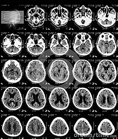 CT Scan Of Brain With Contrast Media. Stock Photo - Image: 53914844