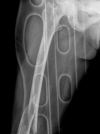 Pathological Fracture Breast Cancer Bone Metastasis Image