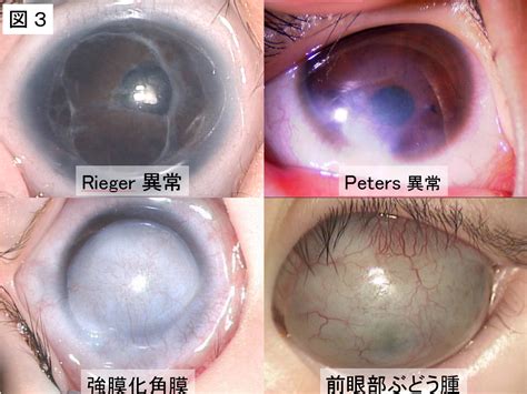 前眼部形成異常（指定難病328） 難病情報センター