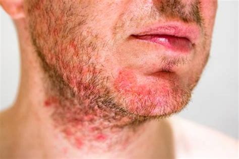 Dermatite Seborroica Sintomi Cause E Rimedi Sanit Informazione