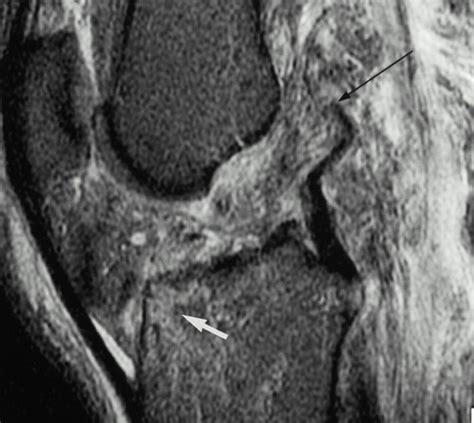 Knee Contusion Mri