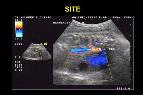 Color Doppler In Fetal Hypoxia PPT