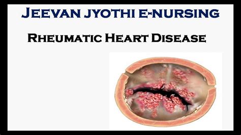 Notes Ii Rheumatic Heart Diseases Ii B Sc Nursing 2nd Year Ii Medical Surgical Nursing Ii Youtube