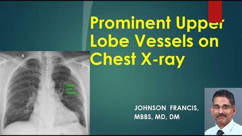 Prominent Upper Lobe Vessels On Chest X Ray Youtube