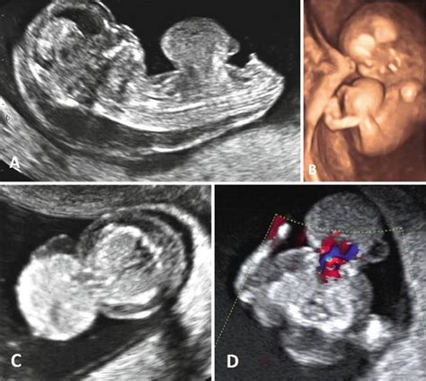 List 93 Pictures Cystic Hygroma Before And After Pictures Stunning