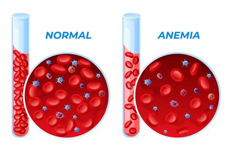 Anaemia- Causes, Diagnosis, Treatment and Prevention - Dr AvinashTank ...