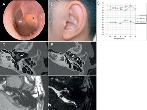 Deviant Facial Nerve Course In The Middle Ear Cavity Brazilian