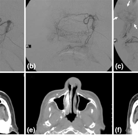 Case 1 Digital Subtraction Angiography Of The Left Internal Maxillary Download Scientific