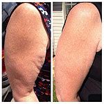 Managing Lipedema In The Upper Arms