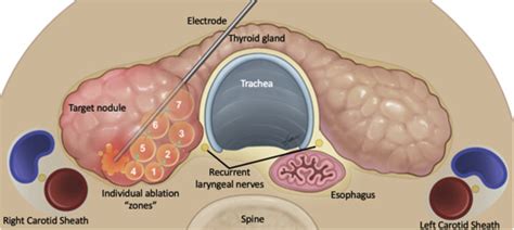 A Comprehensive Review Of Interventional Ablation Techniques For The Management Of Thyroid