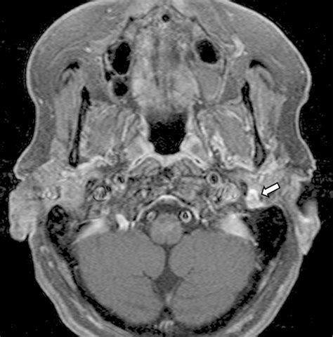 Axial T1 Contrast Enhanced Fat Suppressed Magnetic Resonance Image