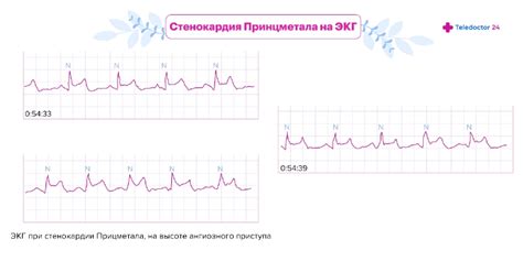 Стенокардия Принцметала: причины, симптомы, лечение, диспансеризация ...