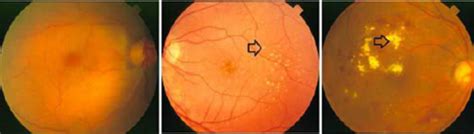 a) Healthy retina b) retina containing drusen c) retina containing ...