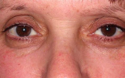 Xanthelasma Yellow Cholesterol Patches Around Eyes Treatment Mr