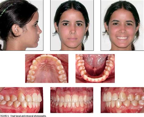 Overbite Malocclusion