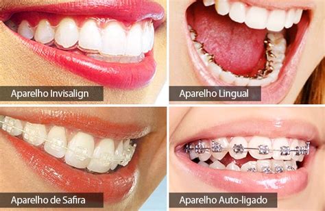 Aparelhos ortodônticos estéticos conheça os principais modelos