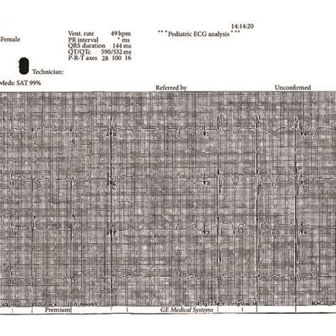 Electrocardiography Of Index Case Iii 2 Shows Third Degree