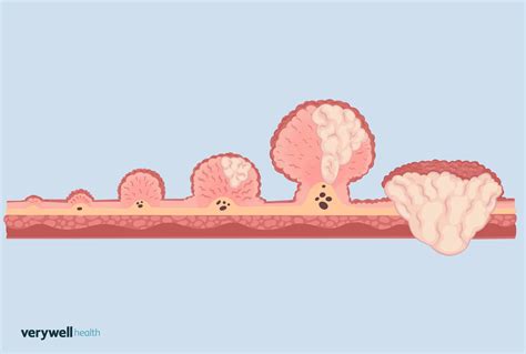 Colon Polyp Size Chart To Gauge Risk