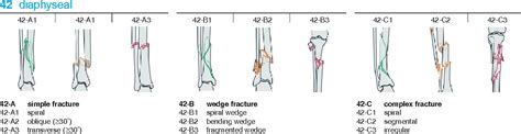 Tibial Shaft Fractures Trauma Orthobullets